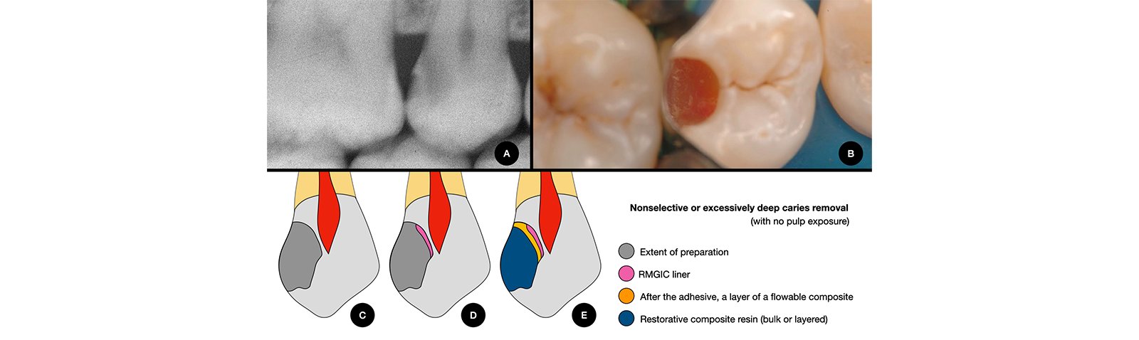 Informative oral care related imagery with a file name of 3MOCSD_Blog_Round13_Robles_Provsional_Permanent_560x460_9.jpg shown on Solventum's "Brain Floss" blog