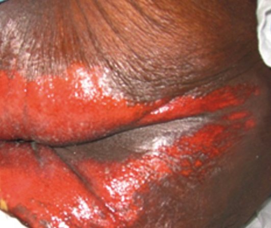 Photo image shows IAD - Dark skin, red and broken