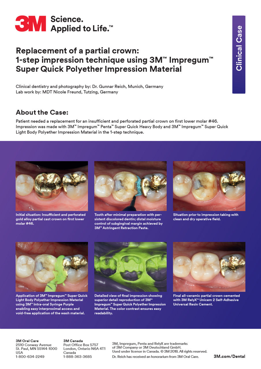 3M™ Impregum™ Super Quick Clinical case: "Replacement of a partial crown