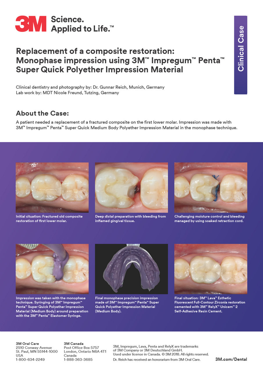 3M™ Impregum™ Penta™ Super Quick Clinical Case "Replacement of a composite restoration"