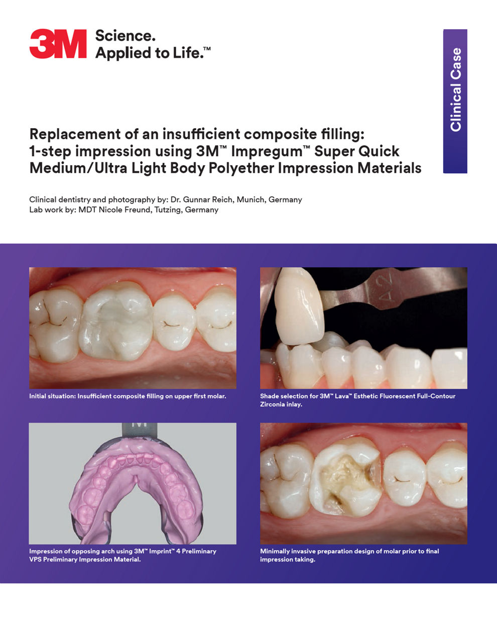 3M™ Impregum™ Penta™ Super Quick Clinical Case "Replacement of an insufficient composite filling "