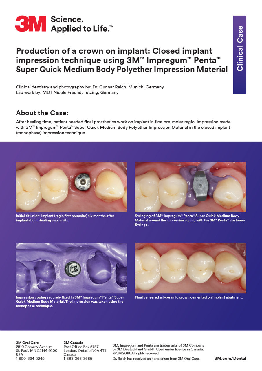 3M™ Impregum™ Penta™ Super Quick Clinical Case "Production of a crown on implant"