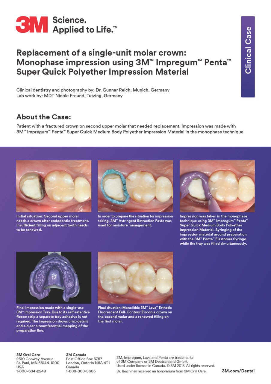 3M™ Impregum™ Penta™ Super Quick Clinical Case "Replacement of a single-unit molar crown"