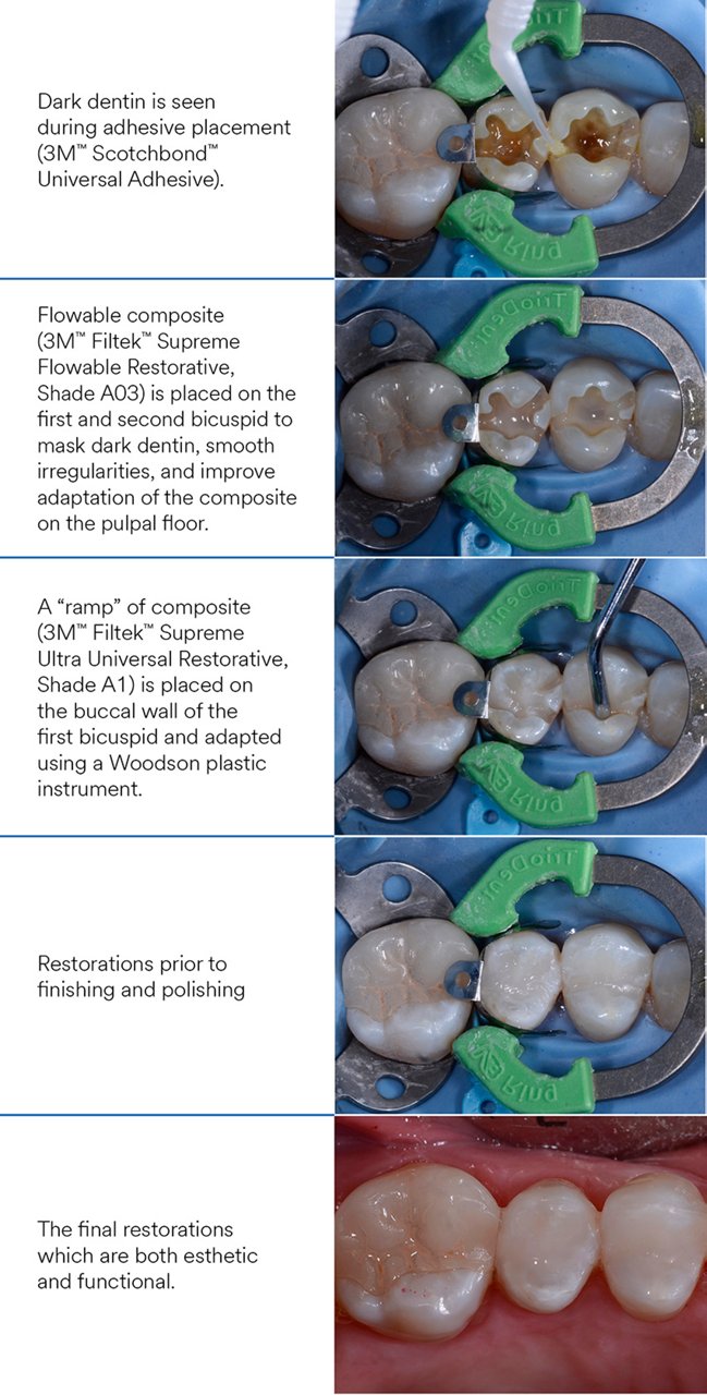 Informative oral care related imagery with a file name of composite_stain_17.jpg shown on Solventum's "Brain Floss" blog