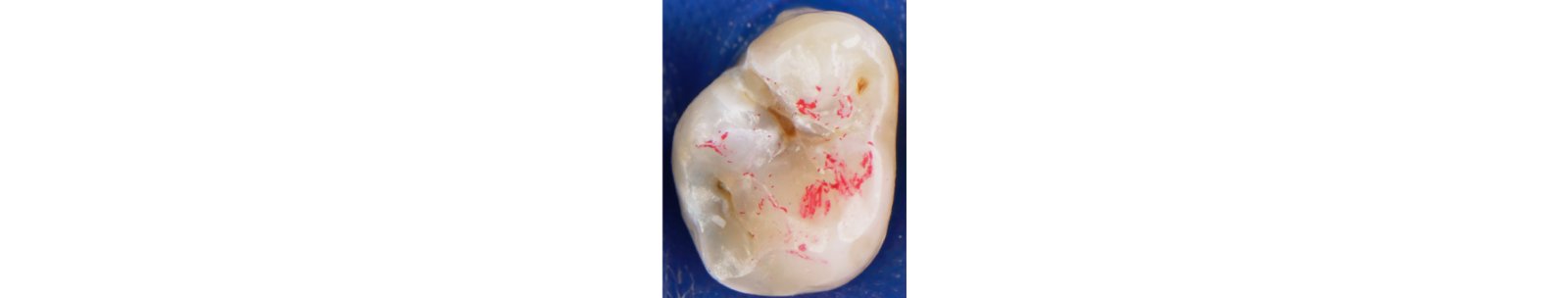 Informative oral care related imagery with a file name of 3MOCSD_Blog_Round14_Olaffson_Implant_560x460_10.jpg shown on Solventum's "Brain Floss" blog
