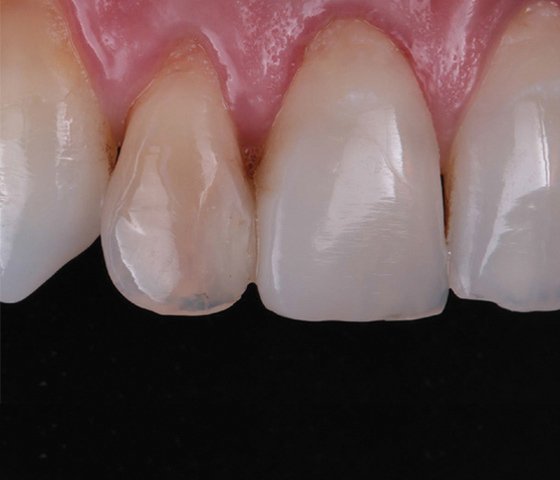 Internally discolored maxillary right lateral incisor