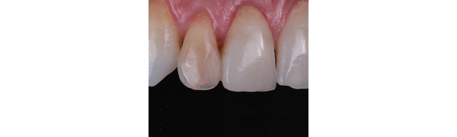 Internally discolored maxillary right lateral incisor