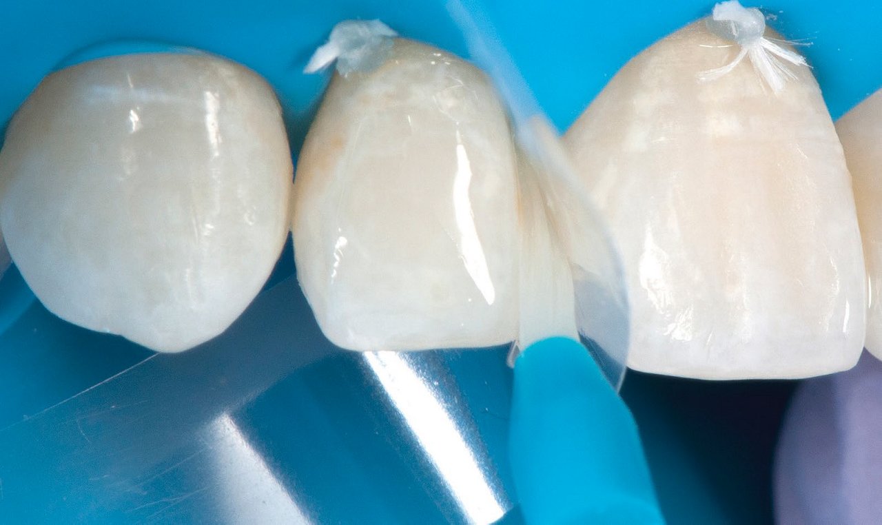 second mylar strip on teeth