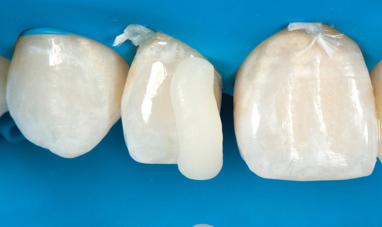 Applying 3M Filtek Supreme XTE Universal Restorative to the tooth