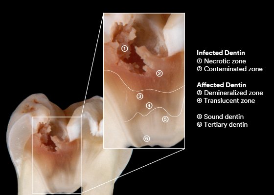 Informative oral care related imagery with a file name of mask-vs-resp.png shown on Solventum's "Brain Floss" blog