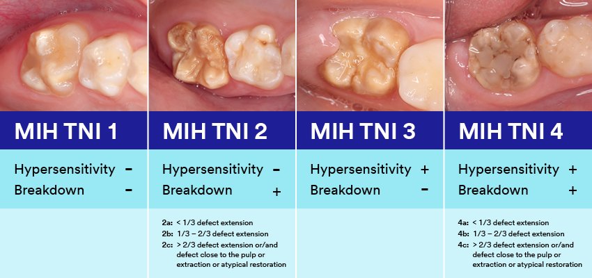 Informative oral care related imagery with a file name of Deciding-how-to-restore-a-root-canal-treated-tooth-2.jpg shown on Solventum's "Brain Floss" blog