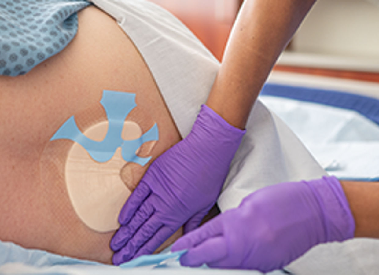 Newsletter image for MSD, 3M Tegaderm Silicone Foam Dressing, resized to 260x260. Original asset ID 2100732.

Clinician applying 3M™ Tegaderm™ Silicone Foam Dressing to a sacral pressure injury. Photo 9