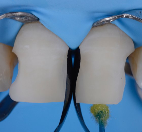 Application of adhesive on dentin