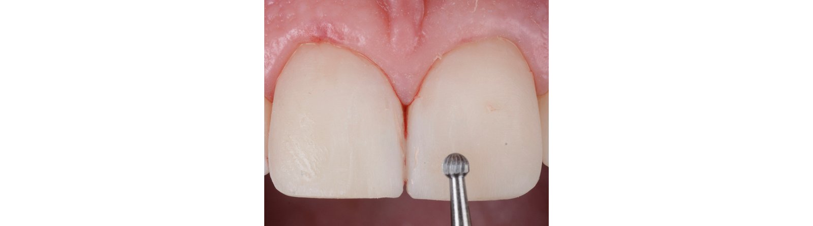 Using a rounded diamond flame bur for shaping