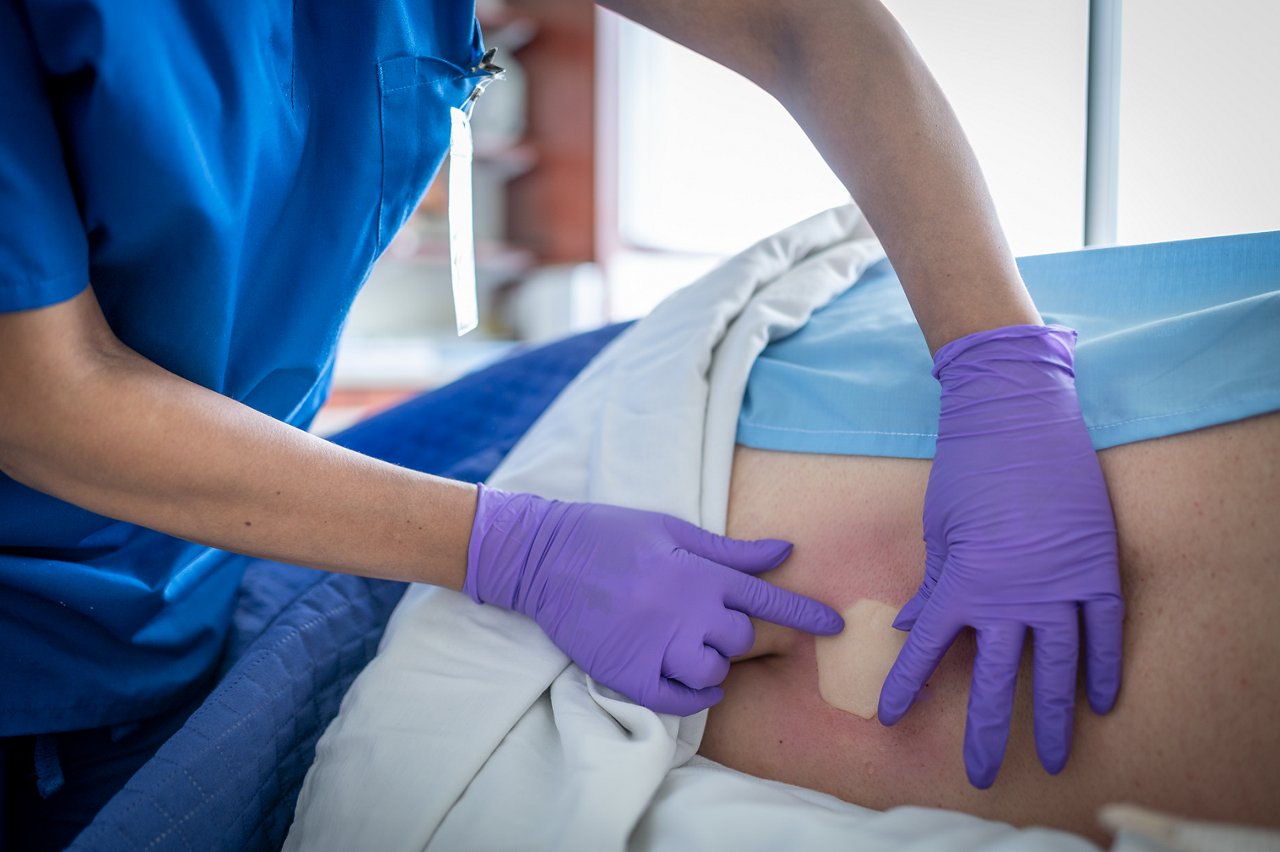 Klinikko levittää 3M™ Promogran Prisma™ -matriisia ristiselän painehaavaan