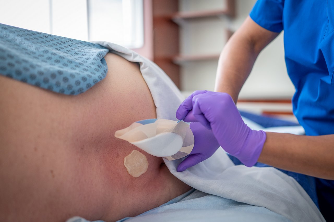 Clínico aplicando a Matriz 3M™ Promogran Prisma™ em úlcera de pressão sacral. Curativo de espuma de silicone sacral 3M™ Tegaderm sendo aplicado por cima
