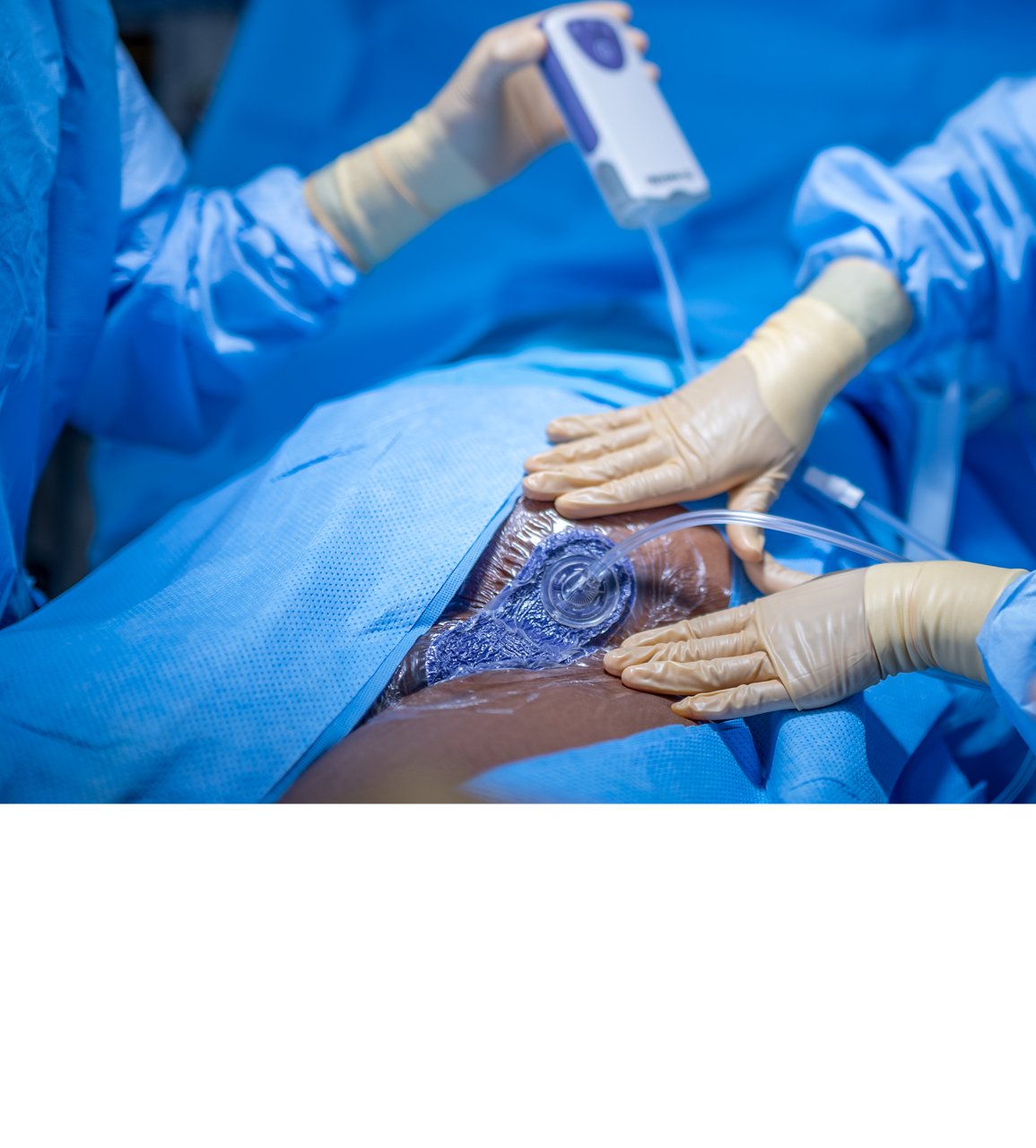 Inzision in der Leiste mit 3M™ Prevena™ Peel and Place System Kit. MedPeople_OR_000262