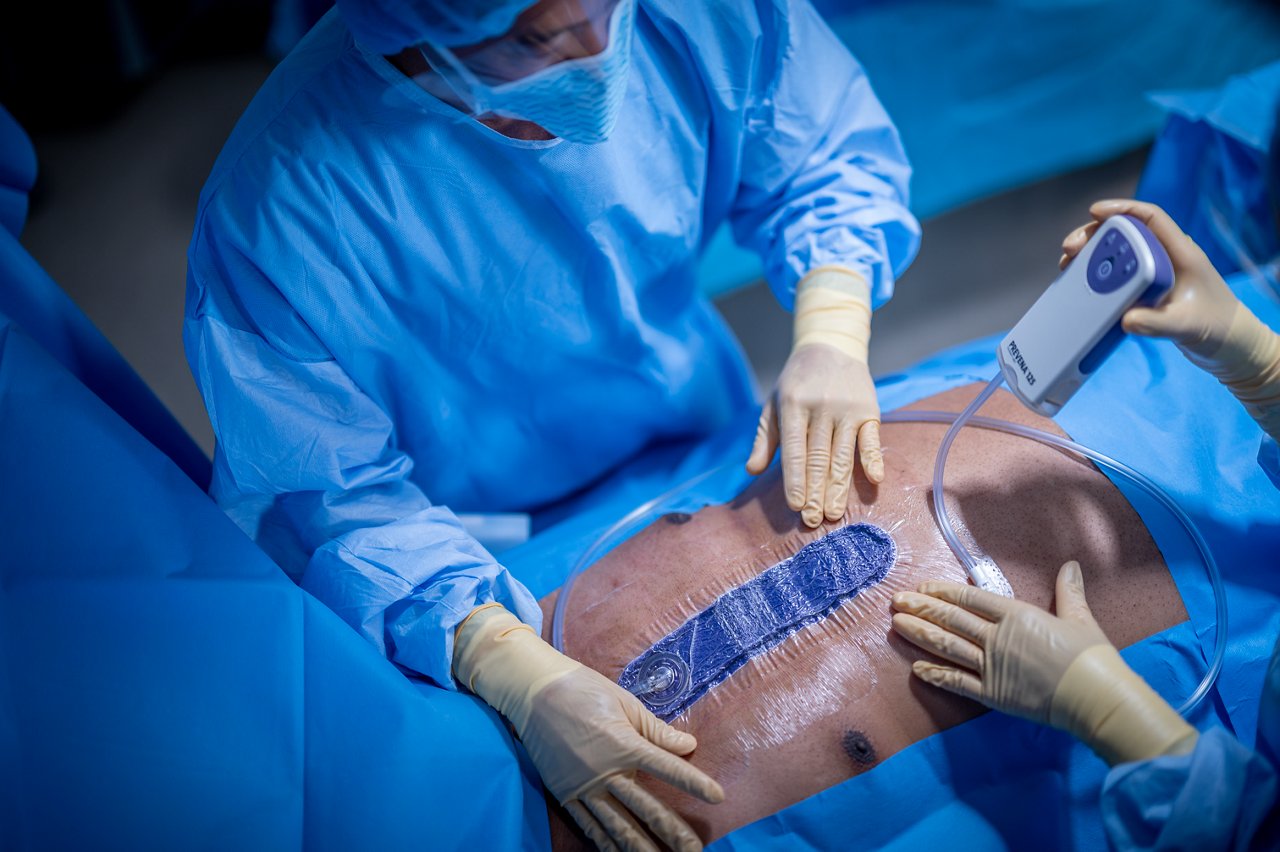 Incision in the sternum with the 3M™ Prevena™ Peel and Place System Kit applied. MedPeople_OR_11045