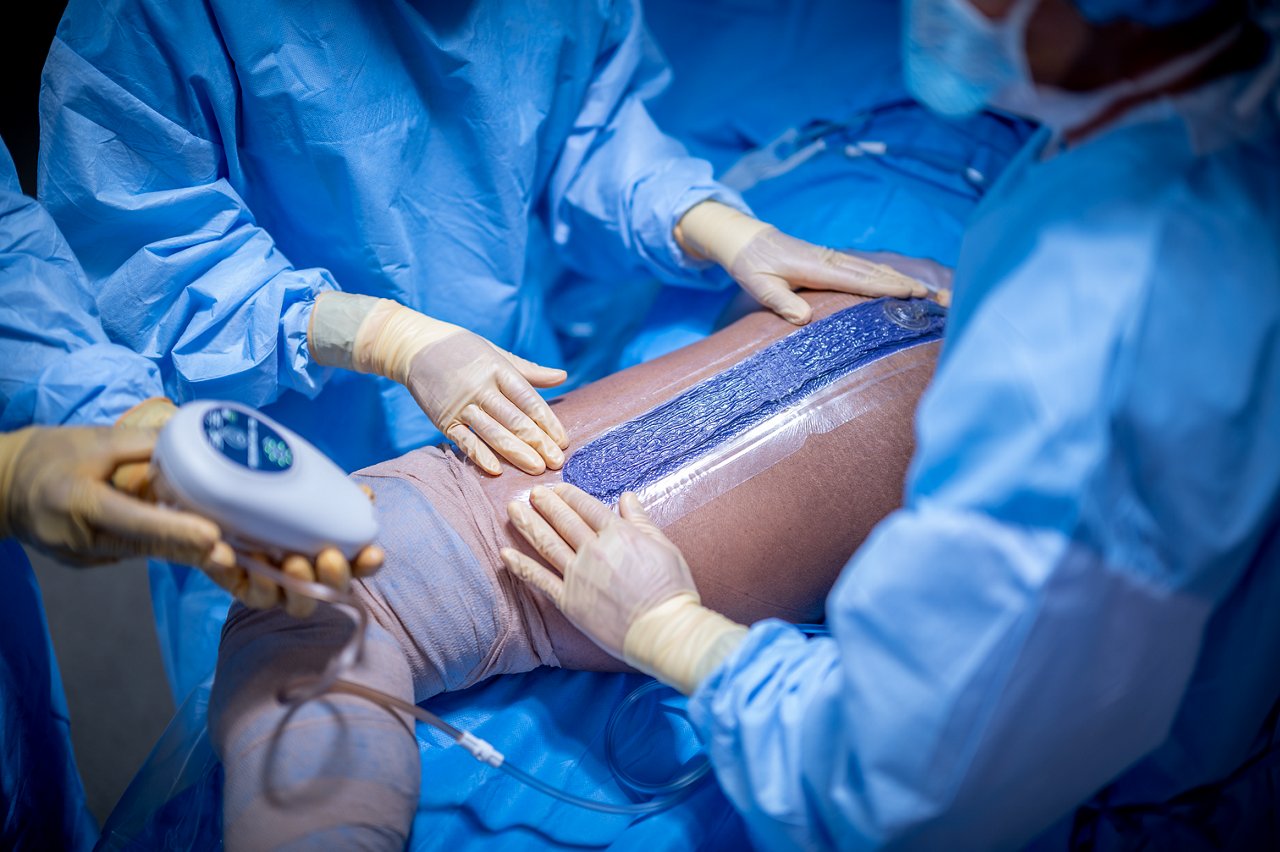 Hip incision with the 3M™ Prevena™ Plus Peel and Place Dressing. MedPeople_OR_11634