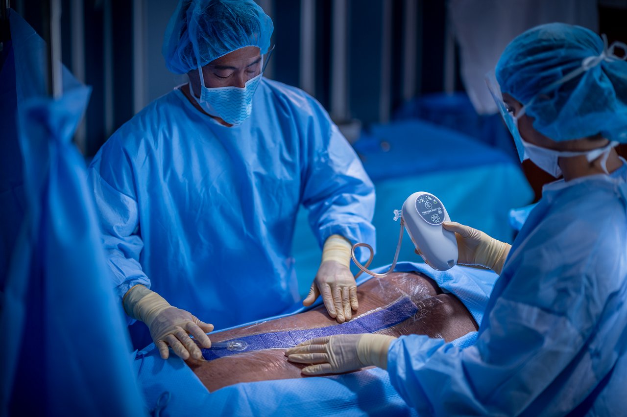 Incisión de la columna con Apósito 3M™ Prevena™ Plus Customizable aplicado. MedPeople_OR_12205