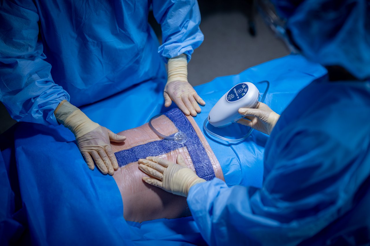 Abdominal incision with 3M™ Prevena™ Plus Customizable Dressing applied. MedPeople_OR_14574, 70-2013-1606-7