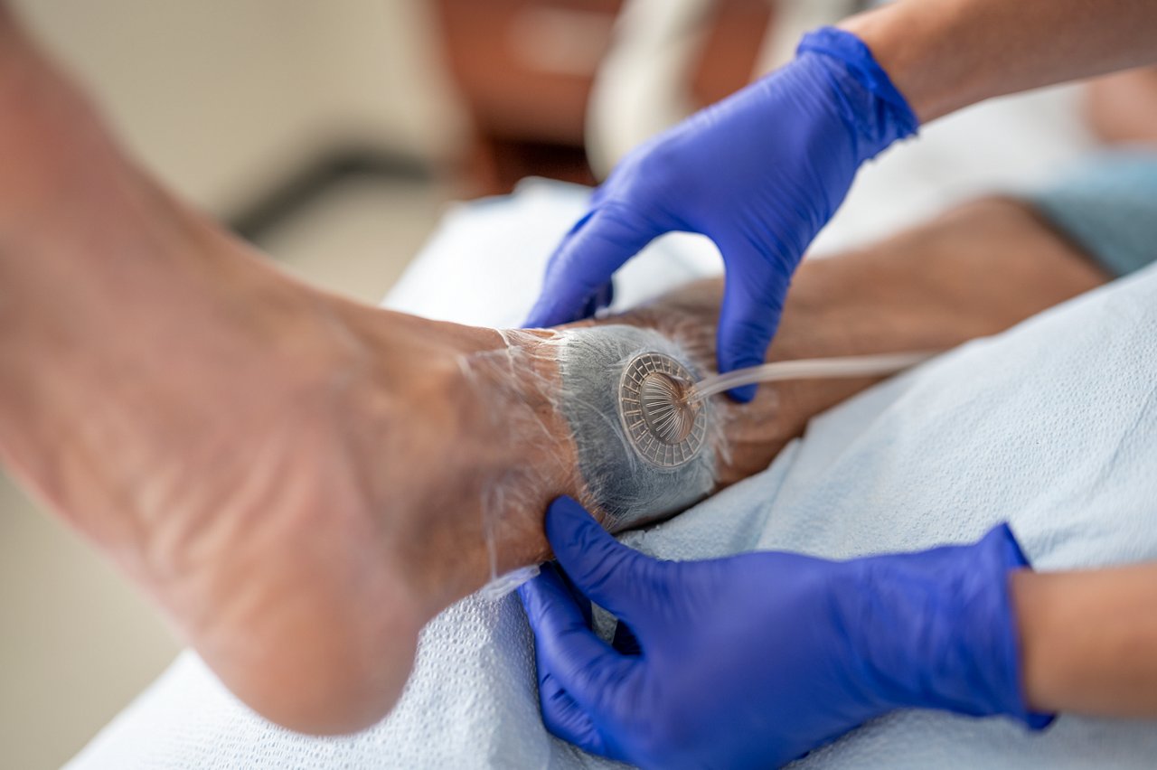 Doctor applying 3M™ V.A.C.® Via Granufoam™ Spiral Dressing to the patient's ankle Photo 3