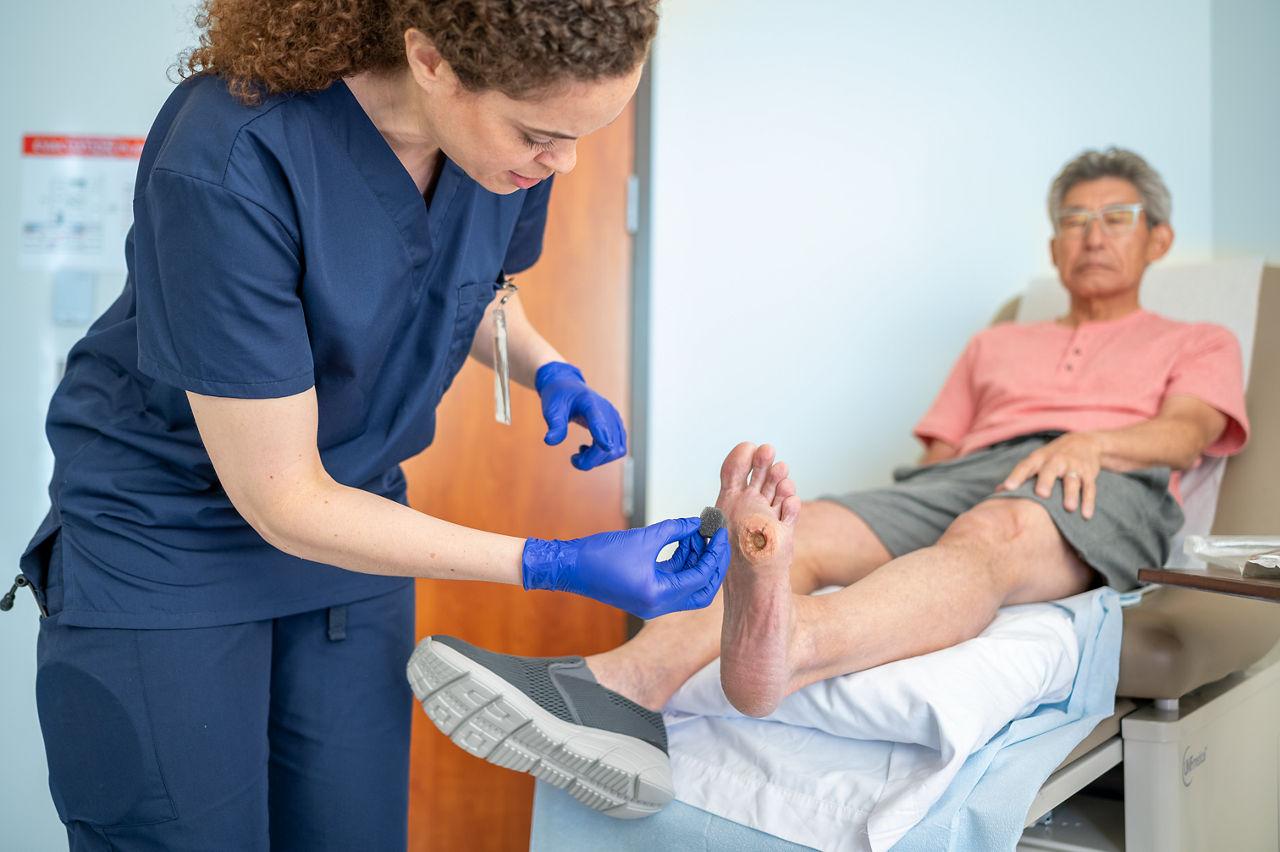 Arzt, der 3M™ V.A.C.® Granufoam™ Verband auf ein diabetisches Fußulkus anwendet. Bild 4