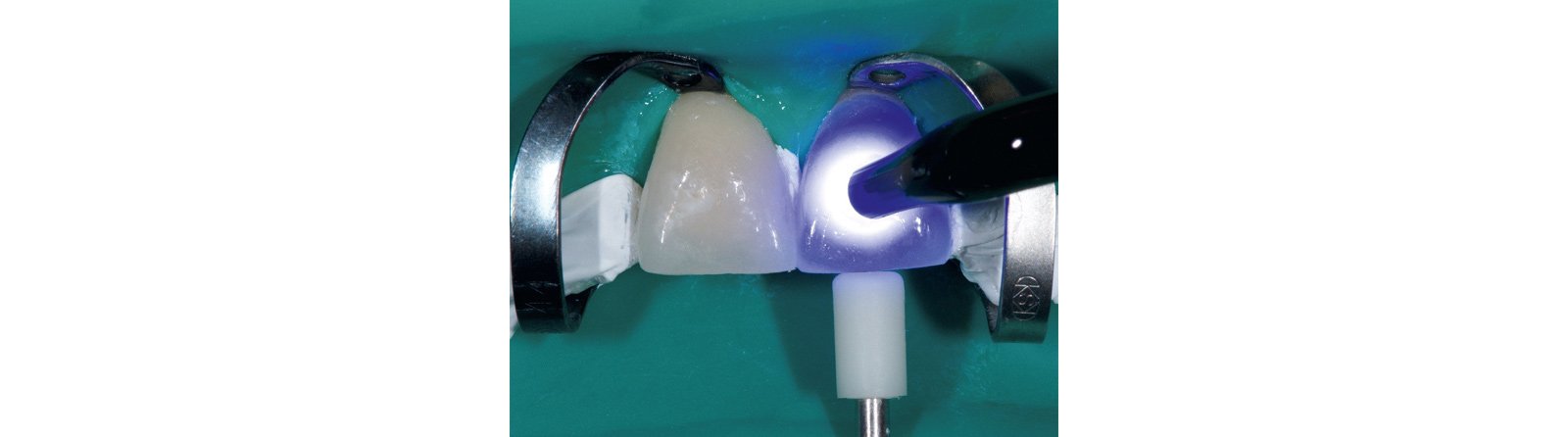 Initial attachment with pinpoint light guide