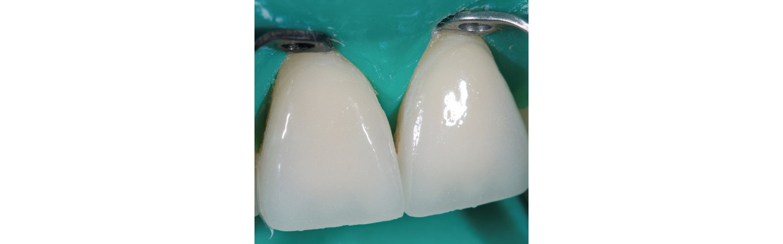 Both veneers in place after clean-up