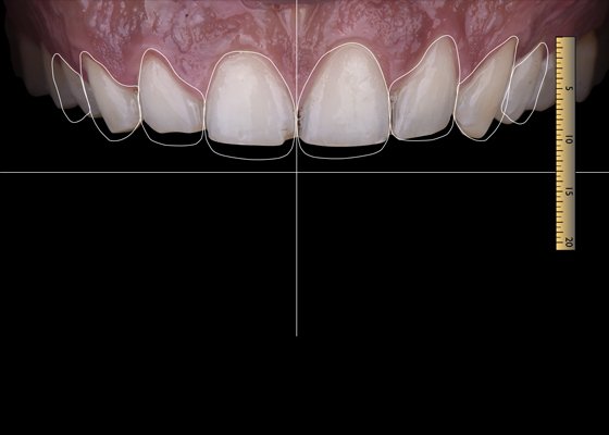 Informative oral care related imagery with a file name of Deciding-how-to-restore-a-root-canal-treated-tooth-560x400-1.jpg shown on Solventum's "Brain Floss" blog