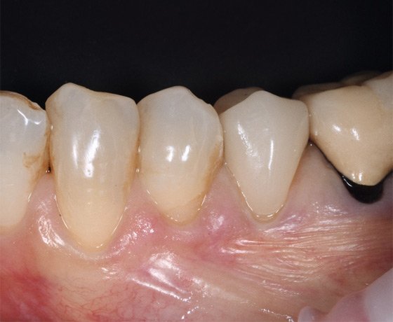 Try-in of glass ceramic overlay