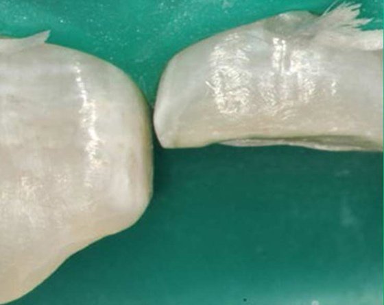 Prepared teeth with infinite bevels