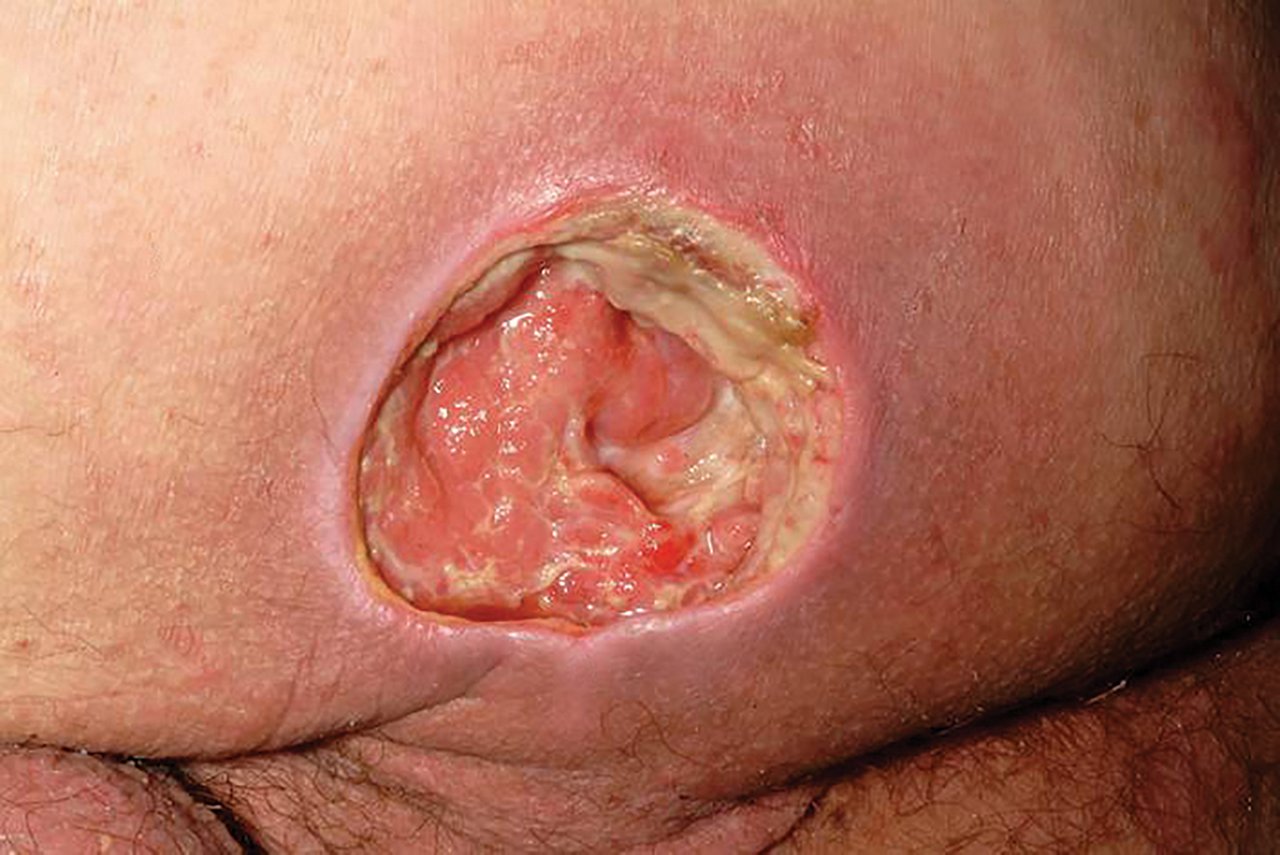 Pressure ulcer, pressure injury, ulcer, Advanced Wound Dressing, AWD, clinical image, cmyk, psd, 29-A-407, PRA-PM-US-00792, 70-2011-8249-3, PRA-PM-US-01130, PRA-PM-EU-00353, 70-2011-8250-1, PRA-PM-EU-00285
