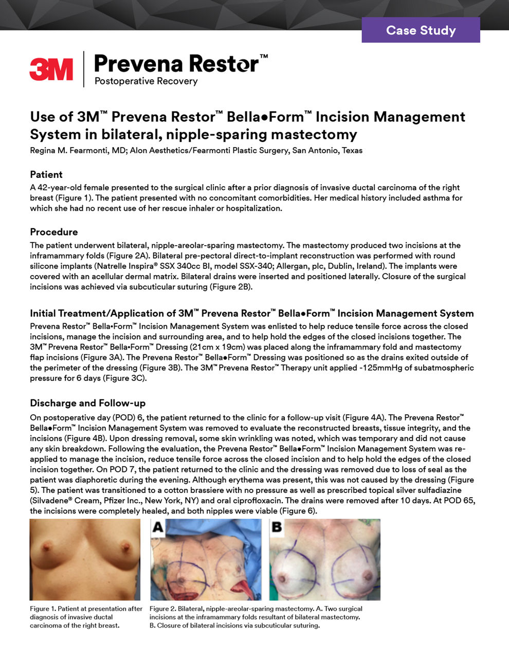 Prevena Restor BellaForm incision management system for mastectomy case study cover preview