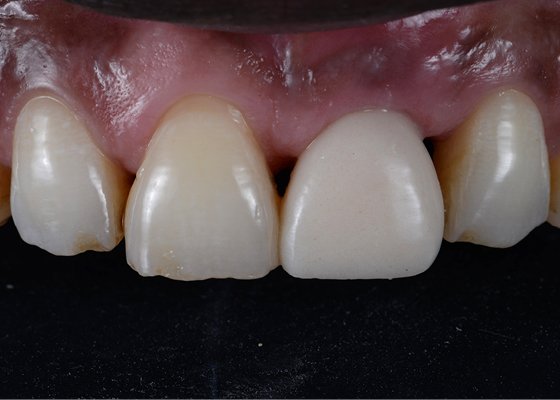 Informative oral care related imagery with a file name of 3MOCSD_IG_Round18_CC_See_GCTabletop_560x460_Blog_5.png shown on Solventum's "Brain Floss" blog