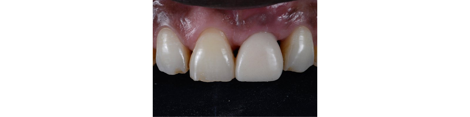 Informative oral care related imagery with a file name of 3MOCSD_IG_Round18_CC_See_GCTabletop_560x460_Blog_5.png shown on Solventum's "Brain Floss" blog
