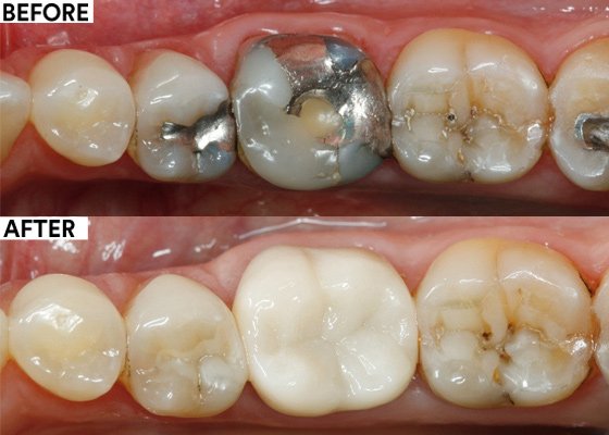 Informative oral care related imagery with a file name of Modeled-composite_10.jpg shown on Solventum's "Brain Floss" blog