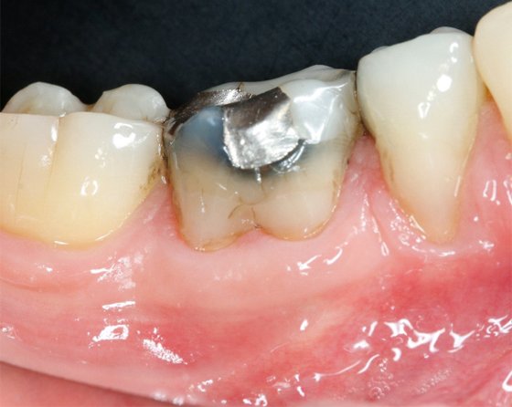 Initial situation (buccal view)