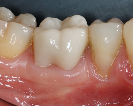 Final situation (buccal view)