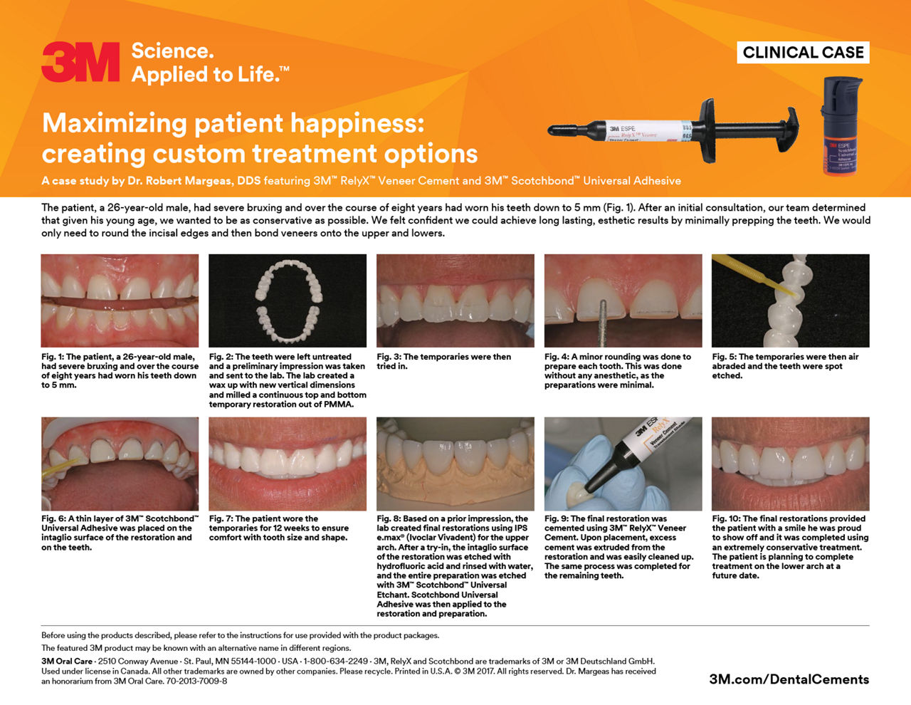 RelyX Veneer clinical case/Margeas