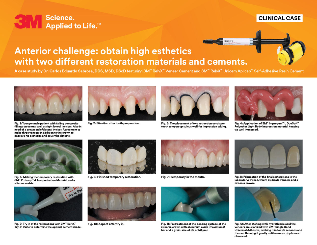 RelyX Veneer and Unicem clinical case/Sabrosa