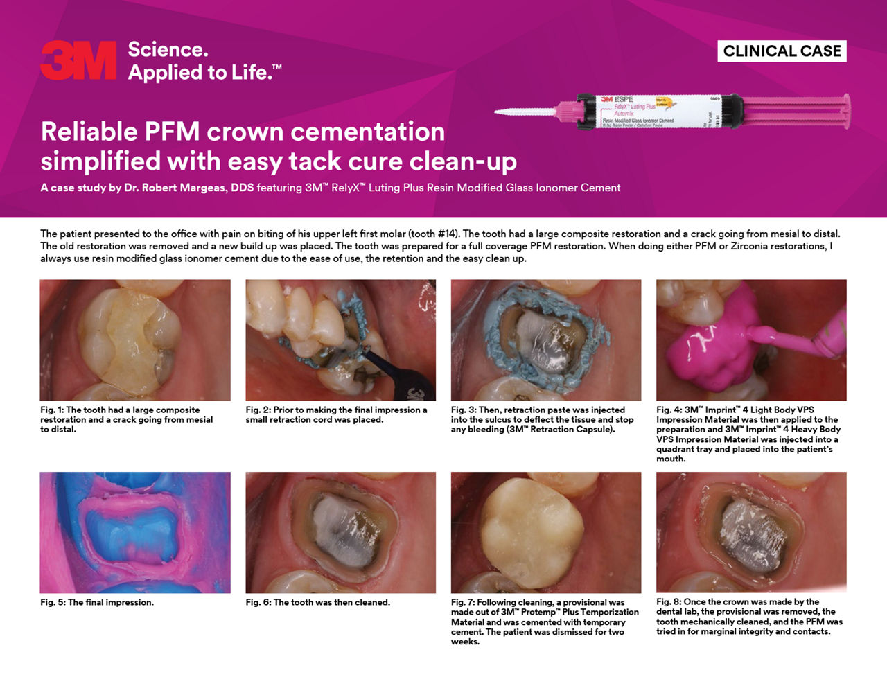 RelyX Luting Plus clinical case/Margeas