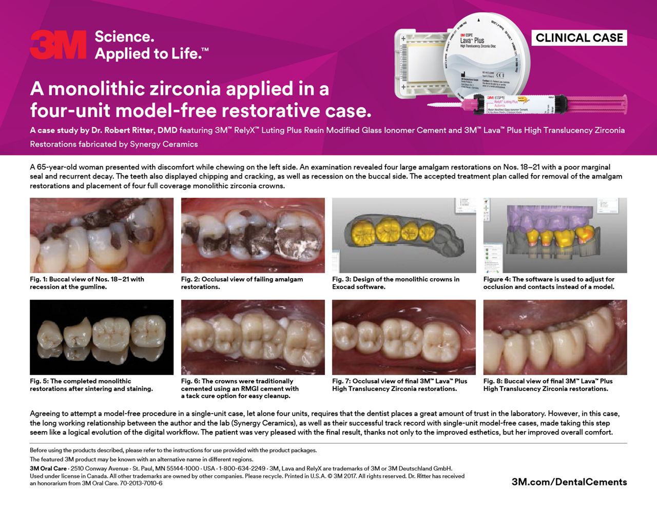 RelyX Luting Plus and Lava Plus clinical case/Ritter