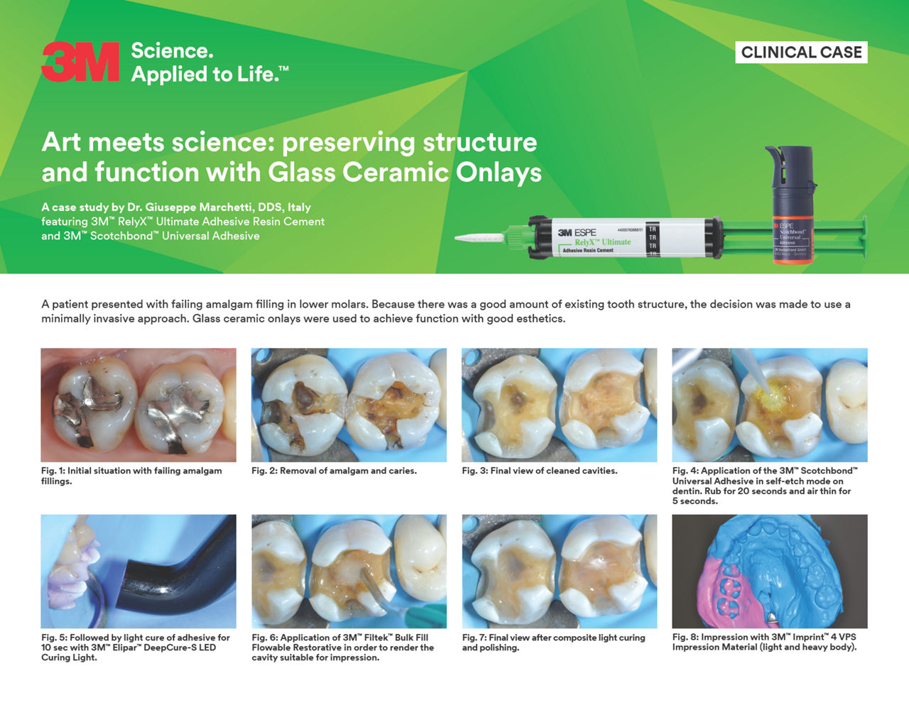 Art meets science: preserving structure and function with Glass Ceramic Onlays 