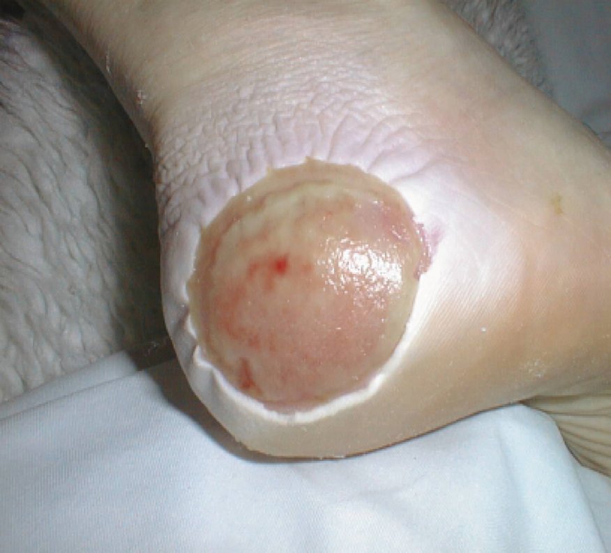 Skin damage due to maceration, periwound moisture-associated skin damage, heel, SDPP, Skin Damage Prophylaxis Program, Cavilon Professional Skin Care, clinical picture, CMYK, tiff, 70-2010-9342-7