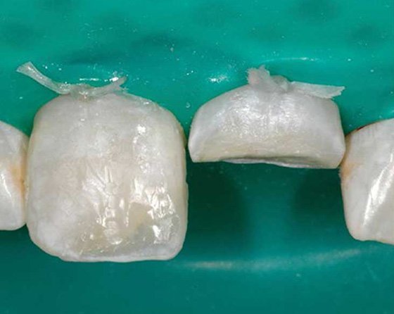 Used composite, Shade A2B, as dentin replacement