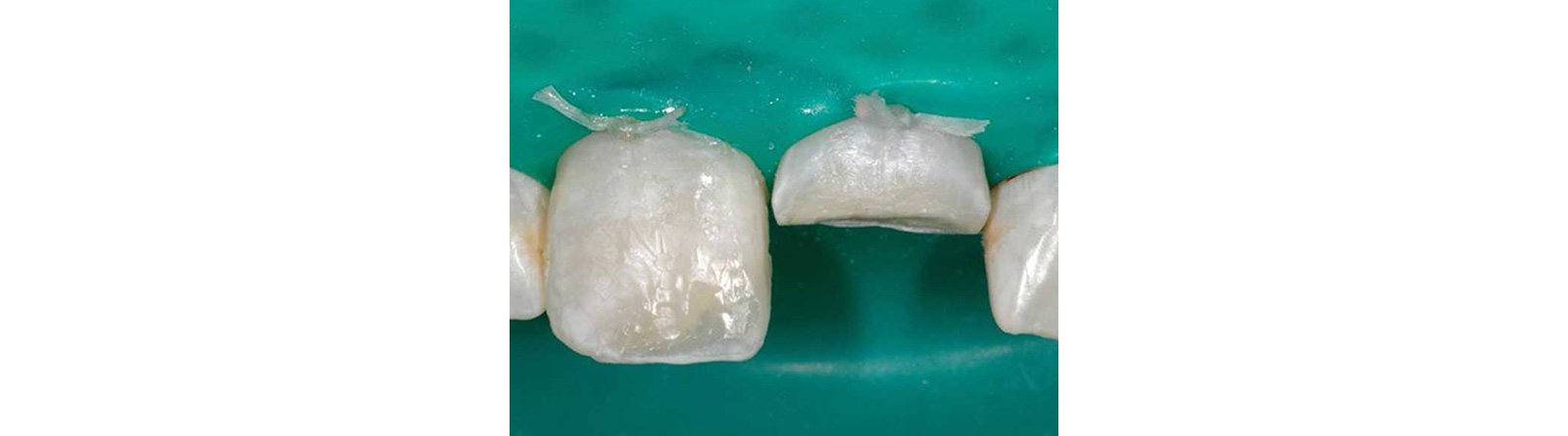 Used composite, Shade A2B, as dentin replacement
