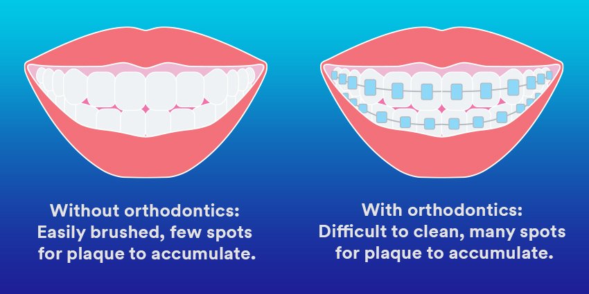 Informative oral care related imagery with a file name of 3M-RelyX-Universal-TR-hand-side-850x526-1.jpg shown on Solventum's "Brain Floss" blog