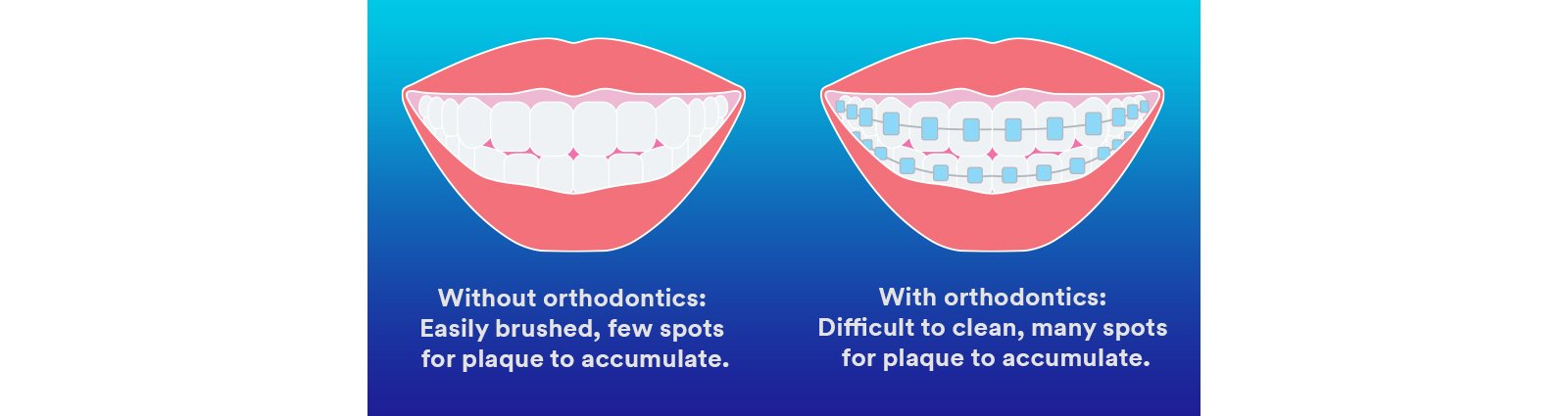 Informative oral care related imagery with a file name of 3M-RelyX-Universal-TR-hand-side-850x526-1.jpg shown on Solventum's "Brain Floss" blog