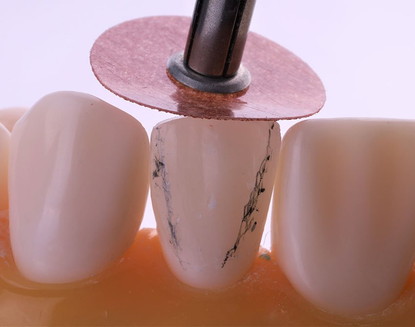 Informative oral care related imagery with a file name of 4-light-curing-universal-adhesive.png shown on Solventum's "Brain Floss" blog